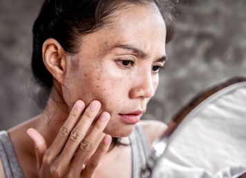 Melasma