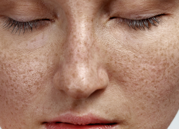 Freckles