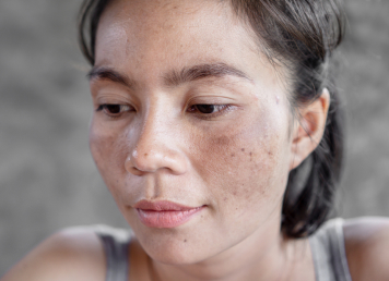 Post-inflammatory hyperpigmentation