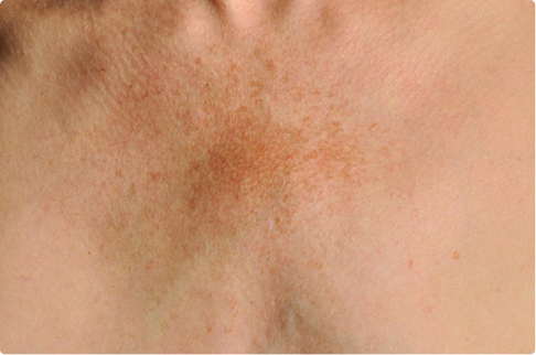 Skin disorders