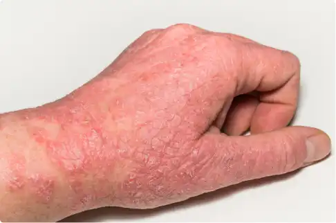 Skin inflammation