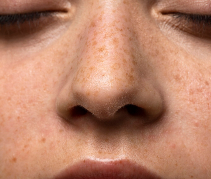 Laser Treatment